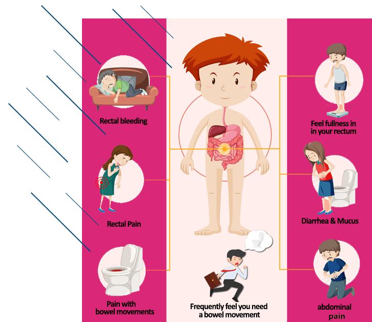 proctitis-symptoms